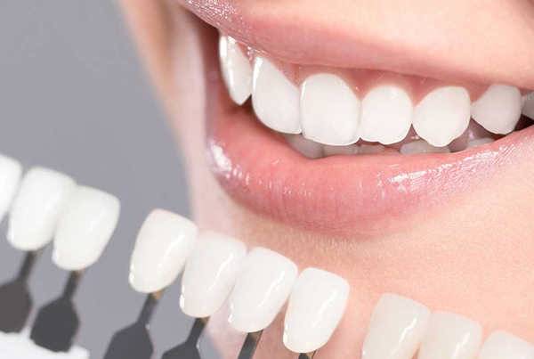 Teeth Whitening (Bleaching)